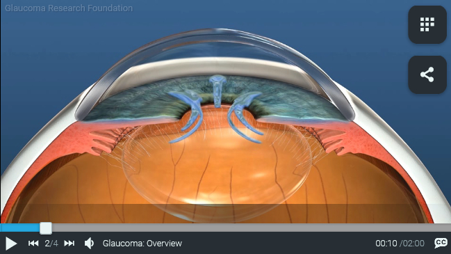 Glaucoma. Research Foundation